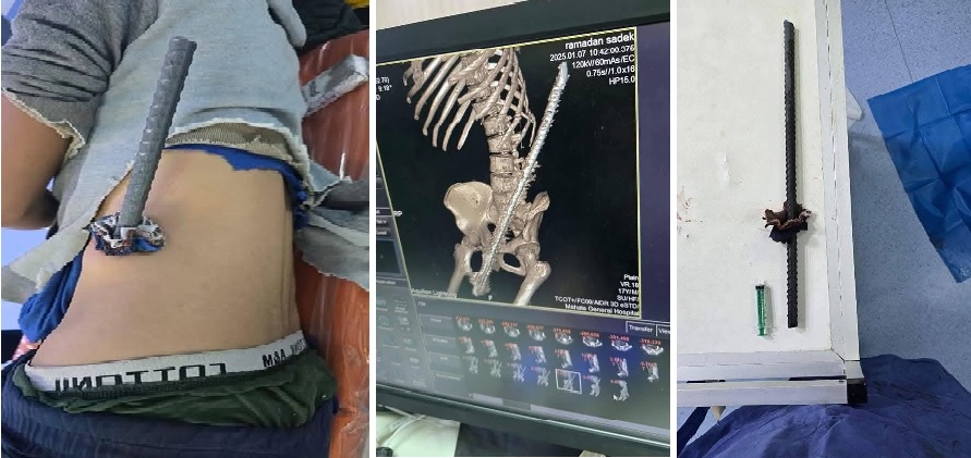 استخراج سيخ حديد من جسم شاب