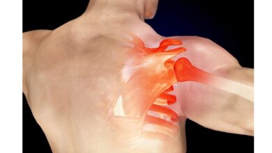 متلازمة انحشار الكتف