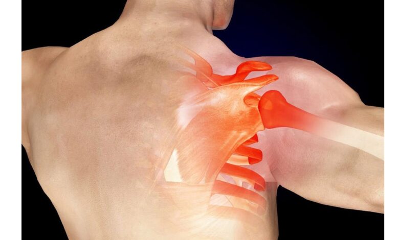 متلازمة انحشار الكتف