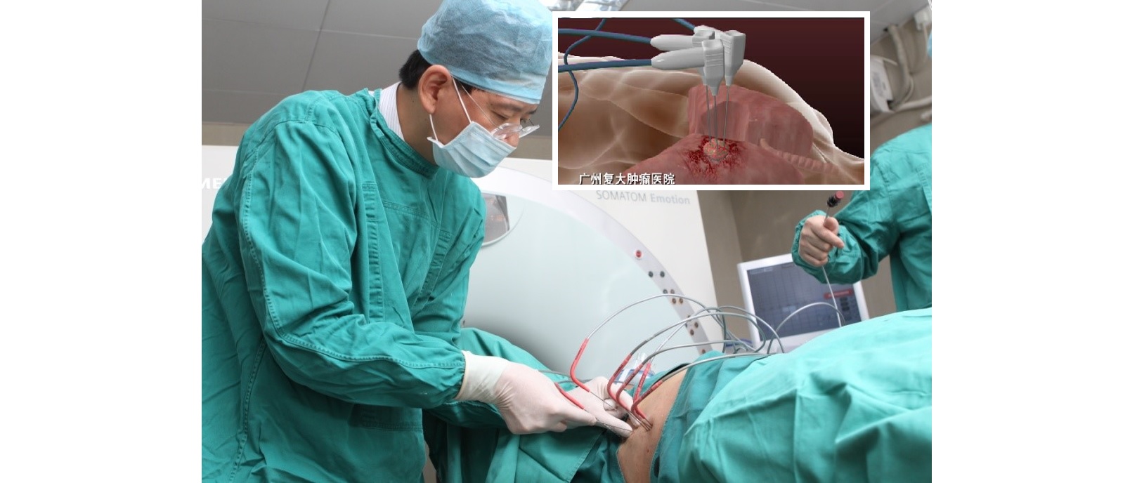 علاج السرطان بتجميد الخلايا